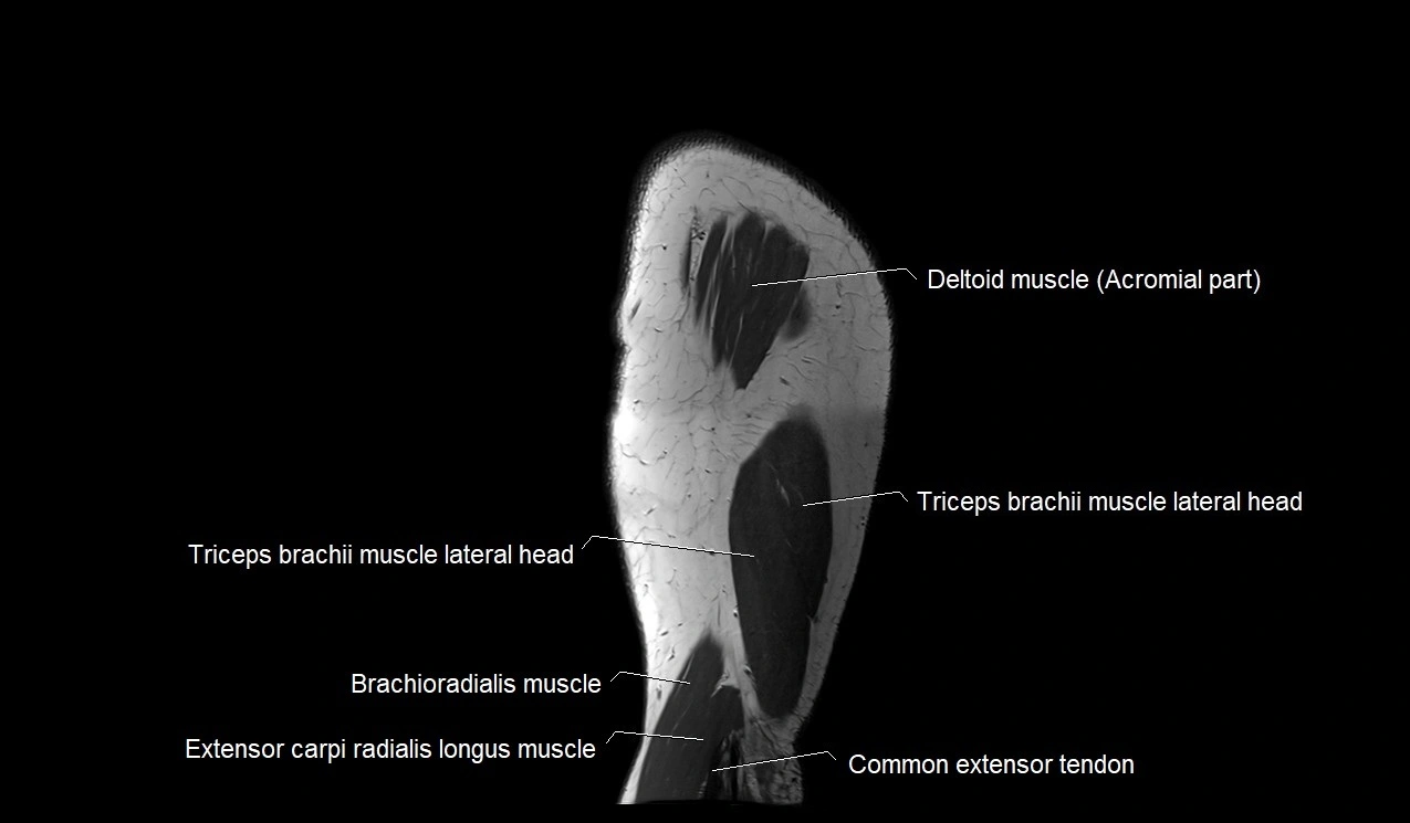 Upper arm (humerus ) saittal cross sectional anatomy 3T image 3.webp